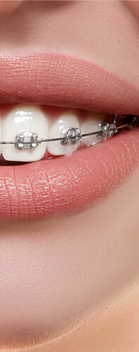 Braces Ceramic